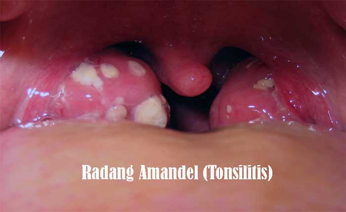 radang amandel (Tonsilitis)